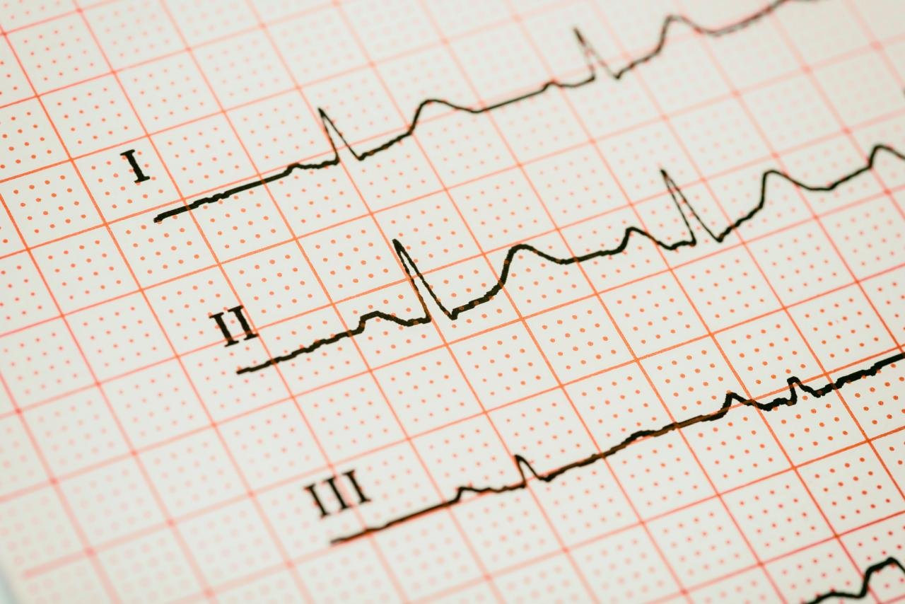 Сердечный ритм кардиограмма