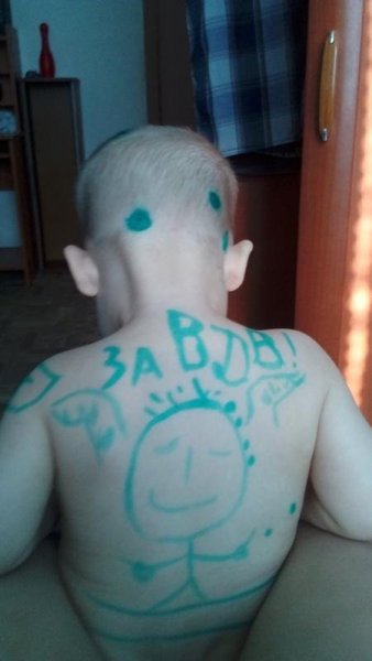 Карантин по ветряной оспе