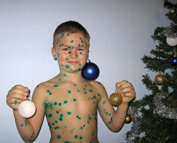 Ветрянка карантин ветрянка