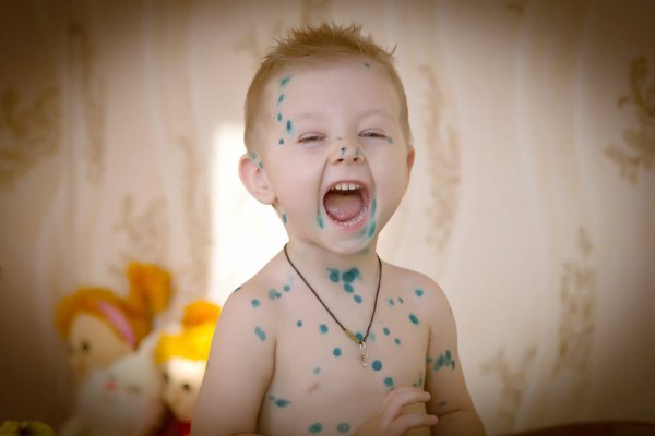 Ветрянка у взрослых тяжелая форма