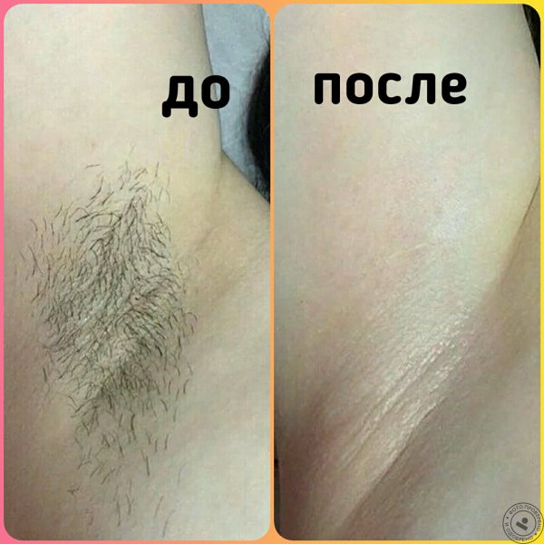 Эпиляция классическое бикини