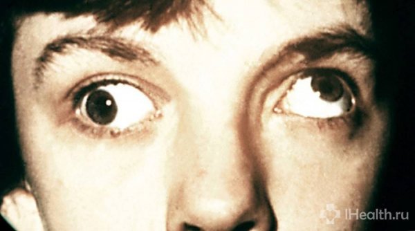 Косые глаза