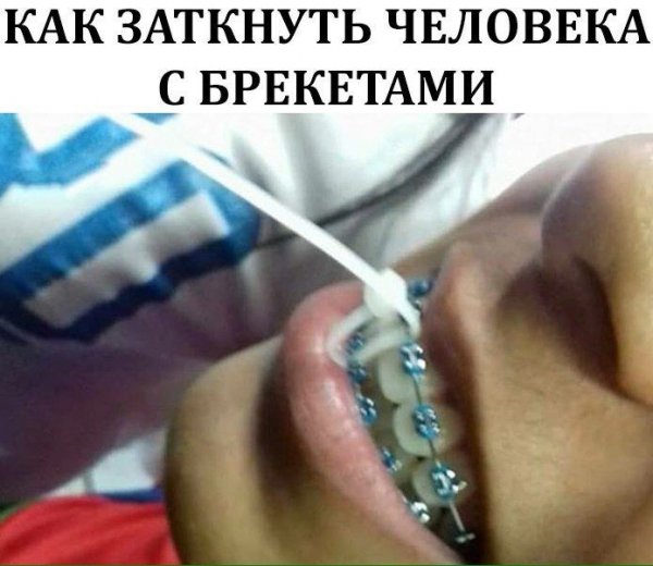 Кэти Перри в клипе с брекетами