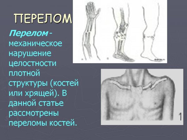 Человек полностью в гипсе