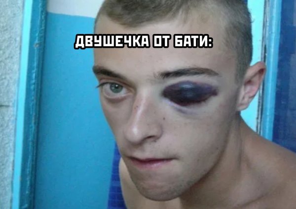 Мужик с синяком под глазом