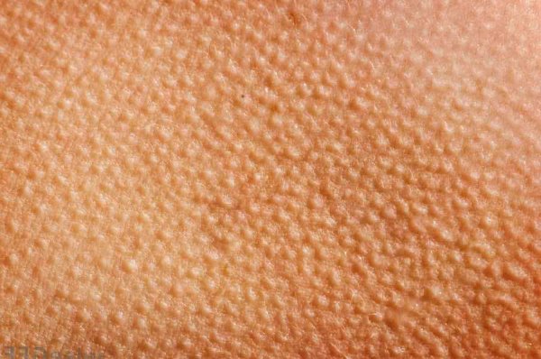 Keratosis pilaris (фолликулярный гиперкератоз)