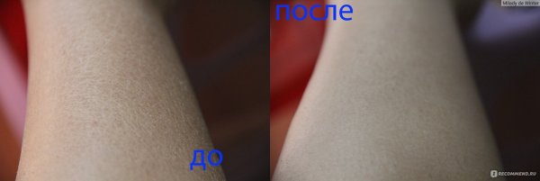 Гусиная кожа заболевание