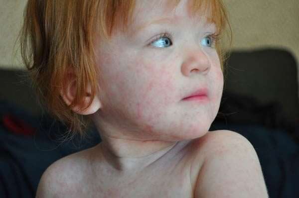 Невоспалительная розеола