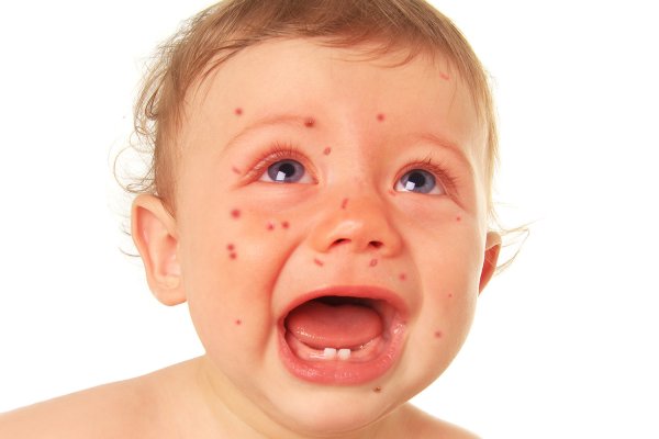 Ветряная оспа высыпания во рту у ребенка