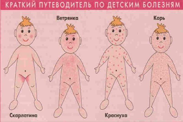 Сыпь при корь краснуха