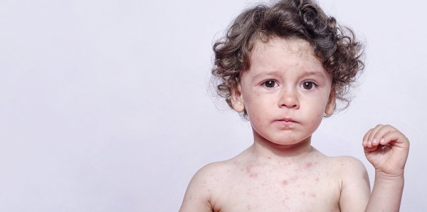Ветрянка у детей от 1 года