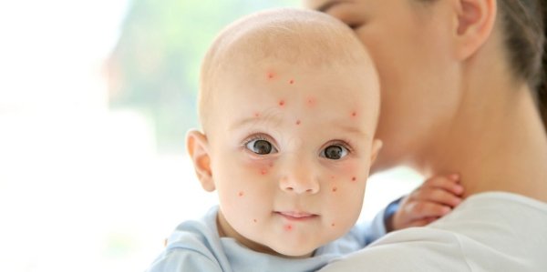 Ветрянка ветряная оспа