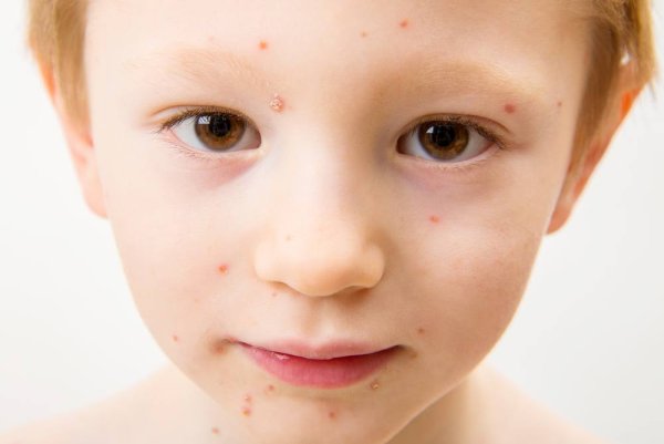 Корь, ветрянка, коревая краснуха.