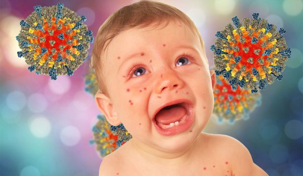 Корь симптомы у детей фото