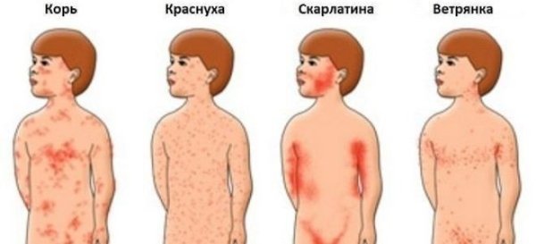 Первые элементы сыпи при кори у детей появляются на