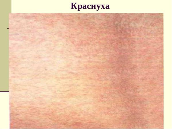 Ветрянка сыпь и краснуха