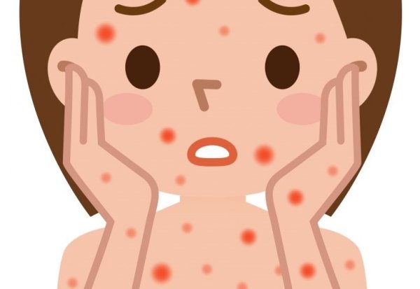 Корь и краснуха и ветрянка у детей