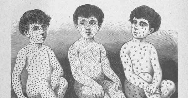 Корь краснуха скарлатина симптомы у детей