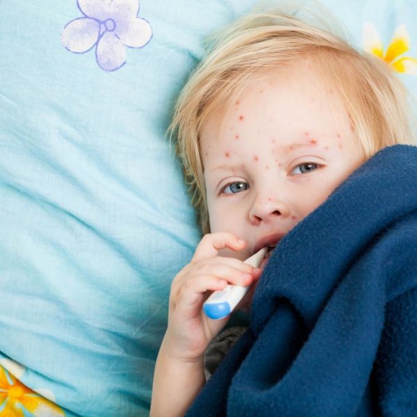 Высыпания при ветрянке у взрослых