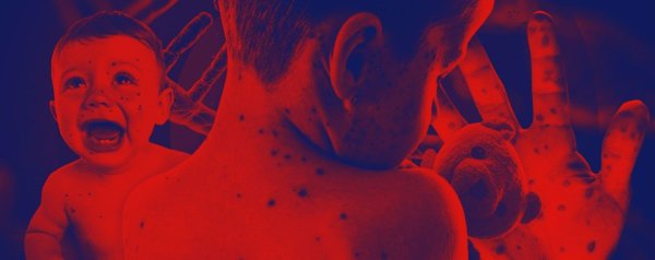 Краснуха корь скарлатина сыпь