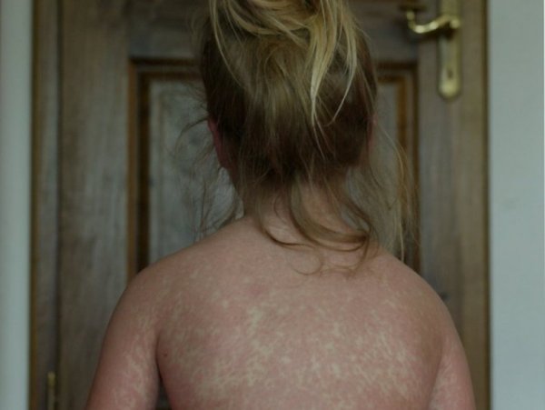 Экзантема мононуклеоз