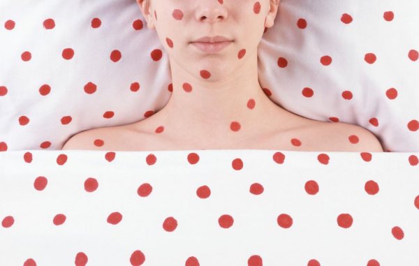 Сыпь корь краснуха сыпь