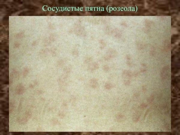 Краснуха сыпь проявления