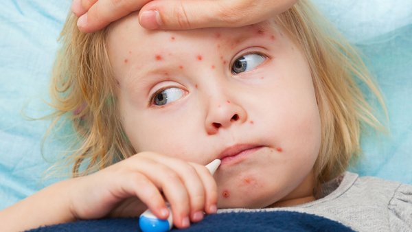 Ветряная оспа у детей сыпь