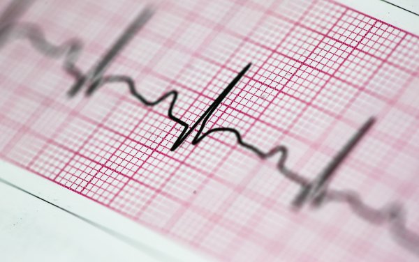 Медицина кардиограмма