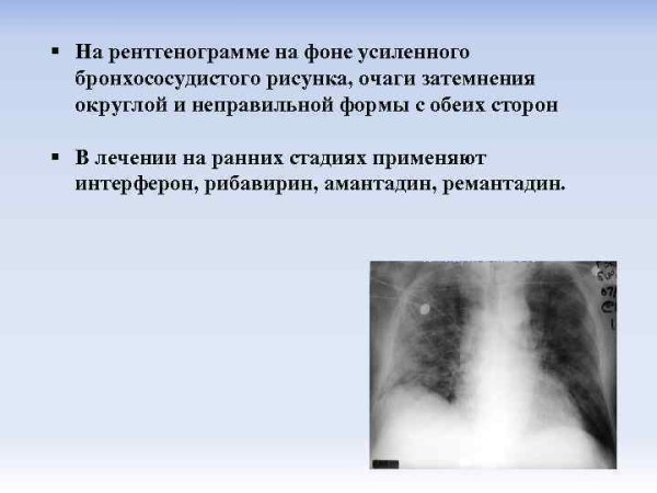 Утолщенные стенки бронхов что это