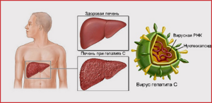 Печень при вирусном гепатите