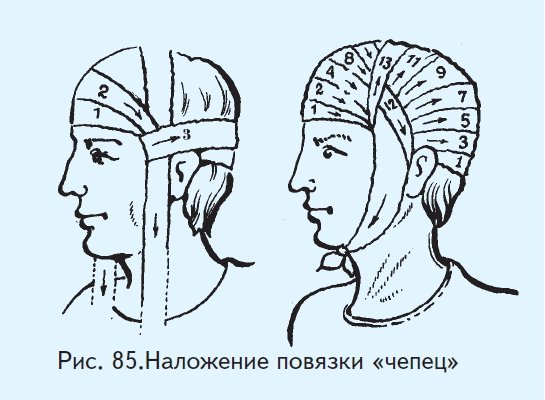 Методика наложения повязки чепец