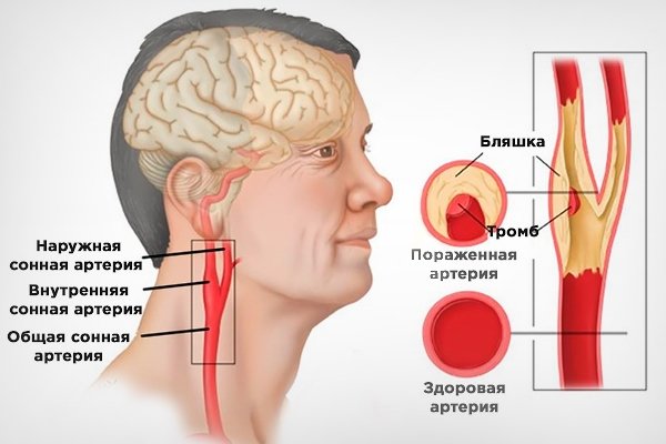 Расположение сонной артерии на шее у человека