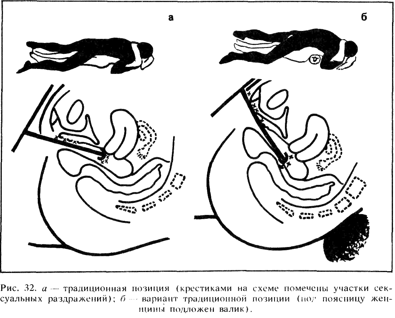 Опущение мочевого пузыря, матки и прямой кишки (пролапс тазовых органов)