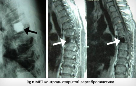 Гемангиолипома позвонка мрт