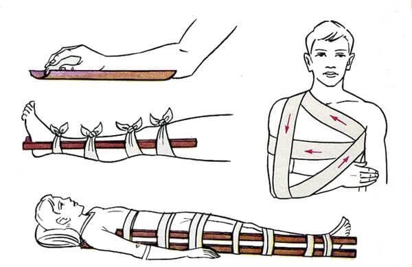 При переломах костей конечностей накладывается шина: