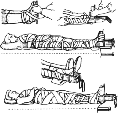 Техника транспортной иммобилизации при переломе бедра