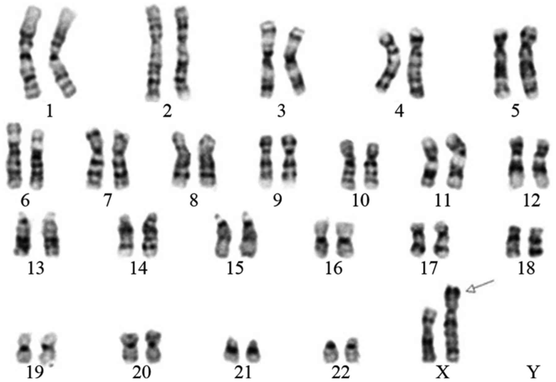 Появление дополнительной хромосомы. Идиограмма кариотипа человека. Кариограмма хромосом. Нормальный кариотип человека 46 хромосом. Кариограмма хромосом мужчины.