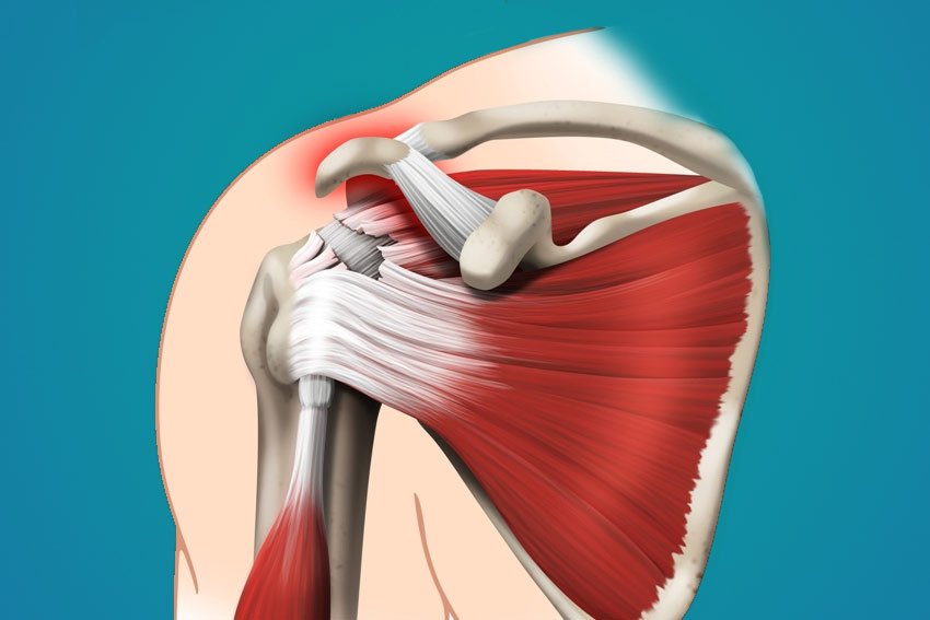 Разрыв надостного сухожилия плечевого сустава лечение. Ротаторная манжета плечевого сустава. Разрыв сухожилия на достные мышцы. Сухожилия ротаторной манжеты. Растяжение сухожилий надостной мышцы.