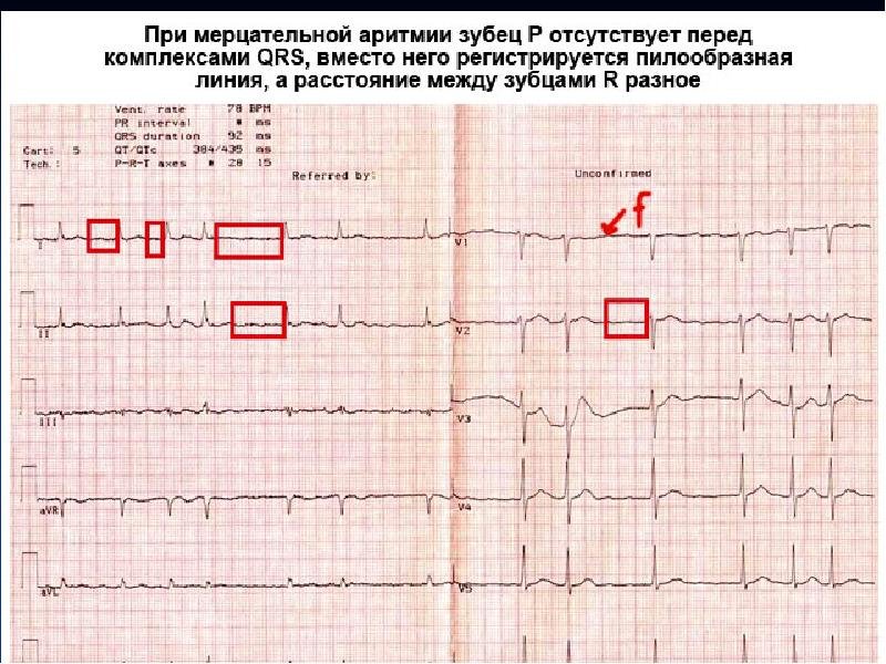 Экг со скольки. ЭКГ Мерцательная аритмия 50 мм. ЭКГ норма расшифровка кардиограммы. Показатели электрокардиограммы сердца норма. Расшифровка показателей ЭКГ сердца взрослого.
