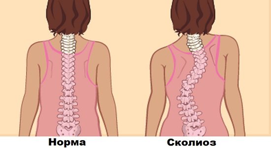 Здоровый позвоночник и сколиоз