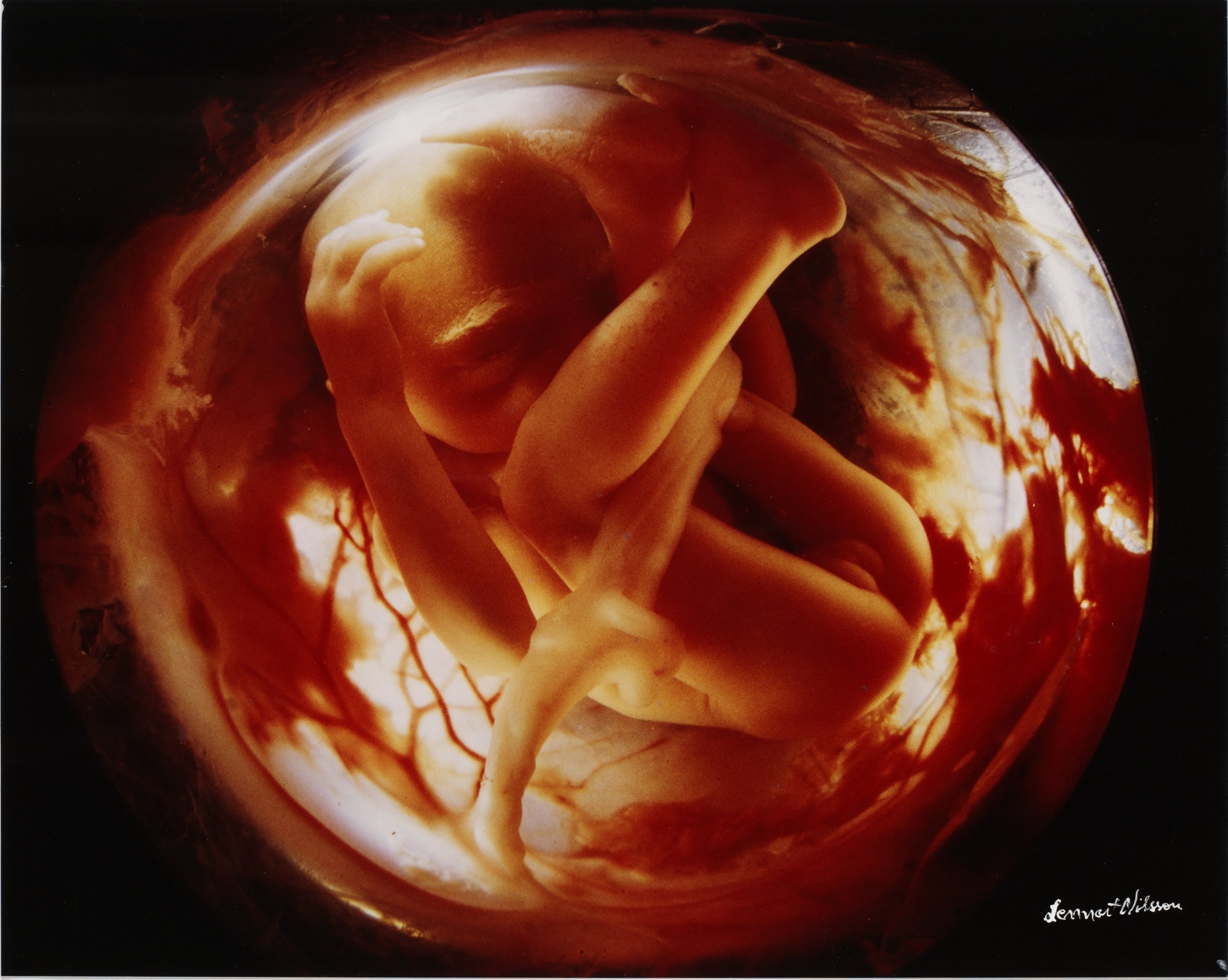 Шум в утробе матери. Эмбрион Леннарт Нильсон. Леннарт Нильсон снимки в утробе. Эмбрион 18 недель Леннарт Нильссон. Леннарт Нильсон Зарождение.