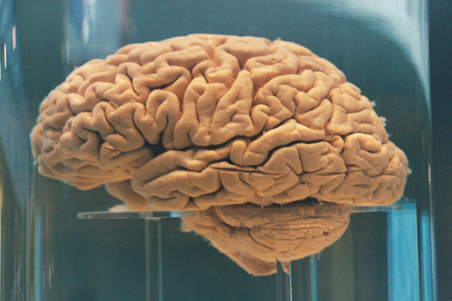 Мозг без крови. Настоящий человеческий мозг. Натовщий мозг человека.