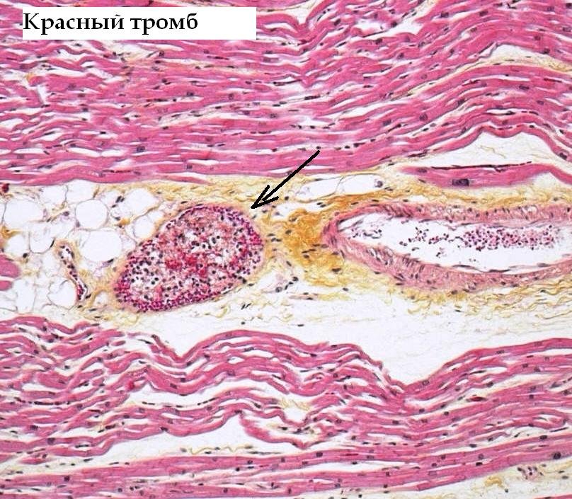 Тромб микропрепарат. Белый тромб микропрепарат. Пристеночный тромб гистология. Смешанный тромб артерии микропрепарат. Белый тромб в артерии микропрепарат.