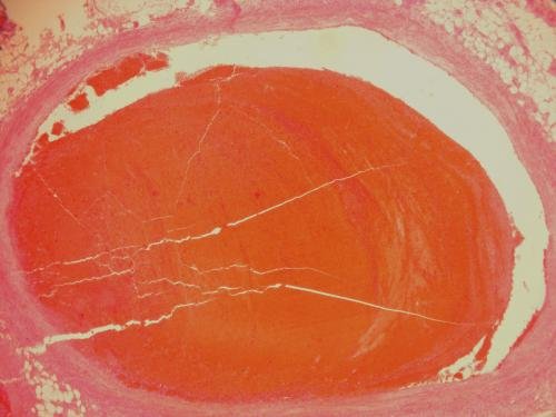 Смешанный тромб. Смешанный тромб микропрепарат. Красный тромб патологическая анатомия. Красный оптурирующий тромб микропрепарат. Смешанный тромб рисунок патанатомия.