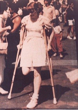 Анна Евстигнеева ампути