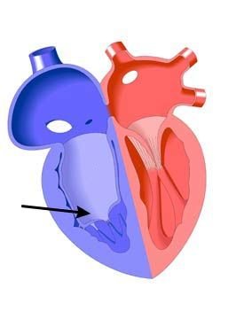 Порок сердца аномалия Эбштейна