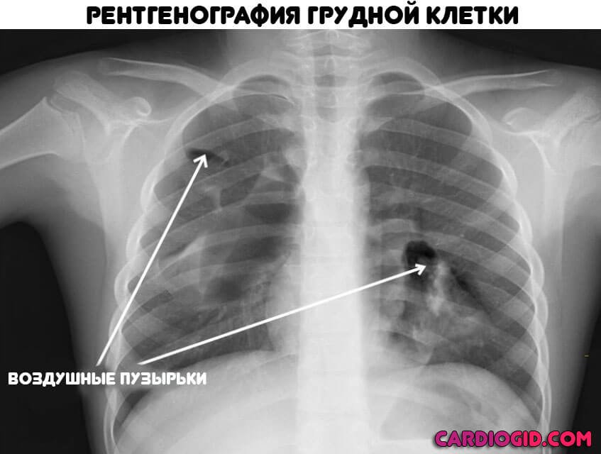 Пузырек воздуха в легком. Воздушная эмболия рентген. Рентгенография грудной клетки. Рентгенограмма органов грудной клетки. Рентген снимок грудной клетки.