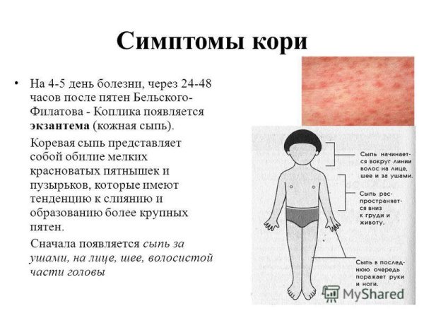 Этапность сыпи корь краснуха