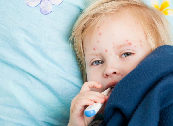 Признаки кори корь симптомы